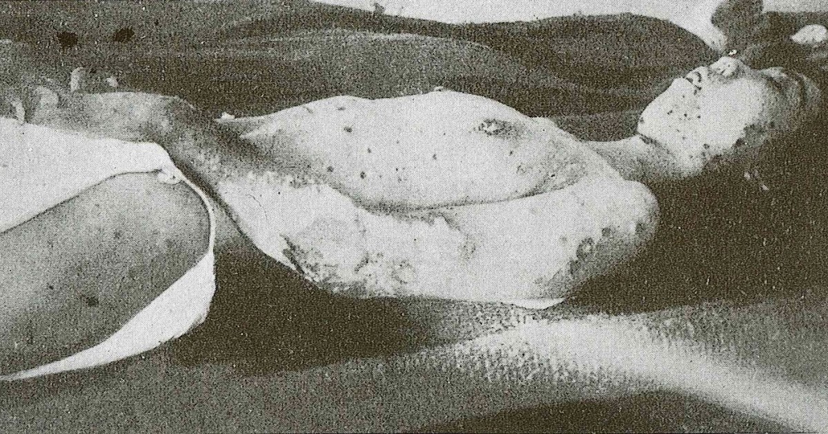 Japan Atomic Bomb (JAB) 日本原爆の会 長崎原子爆弾の放射能の大量被爆により、 熱傷や外傷等