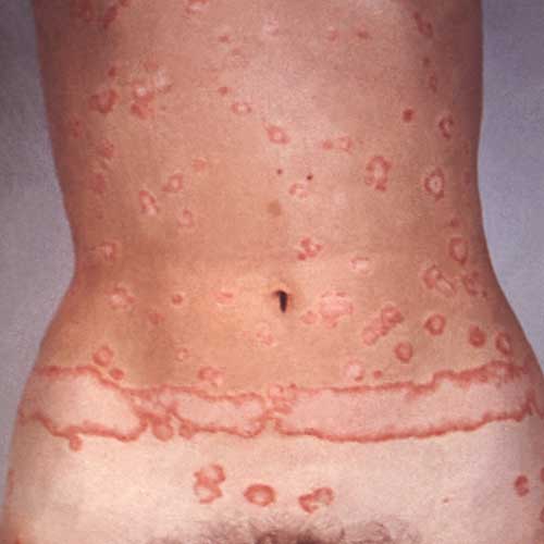 Redefining the Face Of Beauty Skin Disease Psoriasis