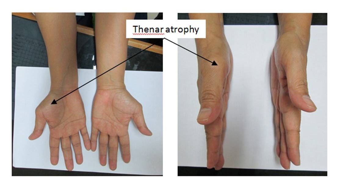 Orthopaedi Knowledges: ABILITY TO UNDERSTAND THE CARPAL TUNNEL SYNDROME ...