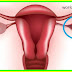 LOOK: REMOVE OVARIAN CYSTS FAST WITH THESE 12 NATURAL REMEDIES!