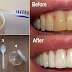 HOW TO GET RID OF PLAQUE AND GUM DISEASE WITHOUT EXPENSIVE TREATMENS