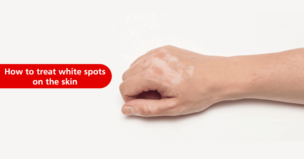 Best Hospitals in Nellore: How to treat white spots on the skin