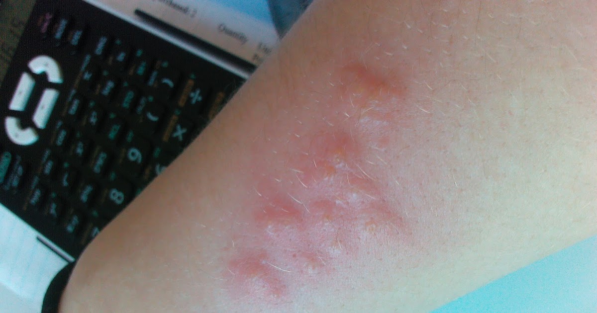 [thewheelchair]: Shingles on the Roof