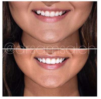 veneers, dr sam Saleh, ora dentistry spa, smile makeover, Beverly Hills dentist, smile before and after, veneers before and after, veneers journey, veneers price, veneers cost, high canine tooth, snaggle tooth, Los Angeles veneers, porcelain veneers,