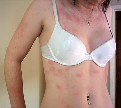 Image result for एलर्जी