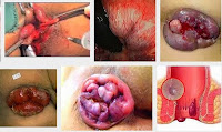 Tips Mudah Sembuhkan Darah Keluar Dari Anus Dengan Obat Alami Tips Mudah Sembuhkan Darah Keluar Dari Anus Dengan Obat Alami