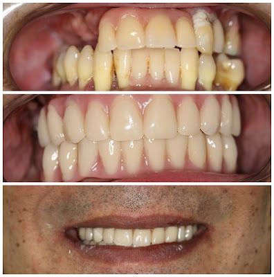 Carga imediata