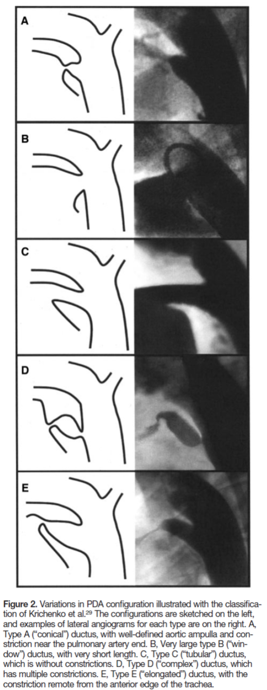Pedi cardiology PDA Morphologic type by Angiography (1989)