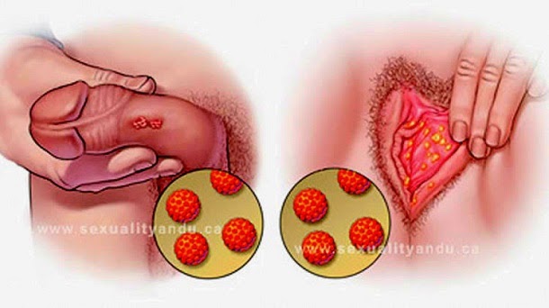 como se contrae virus del papiloma humano