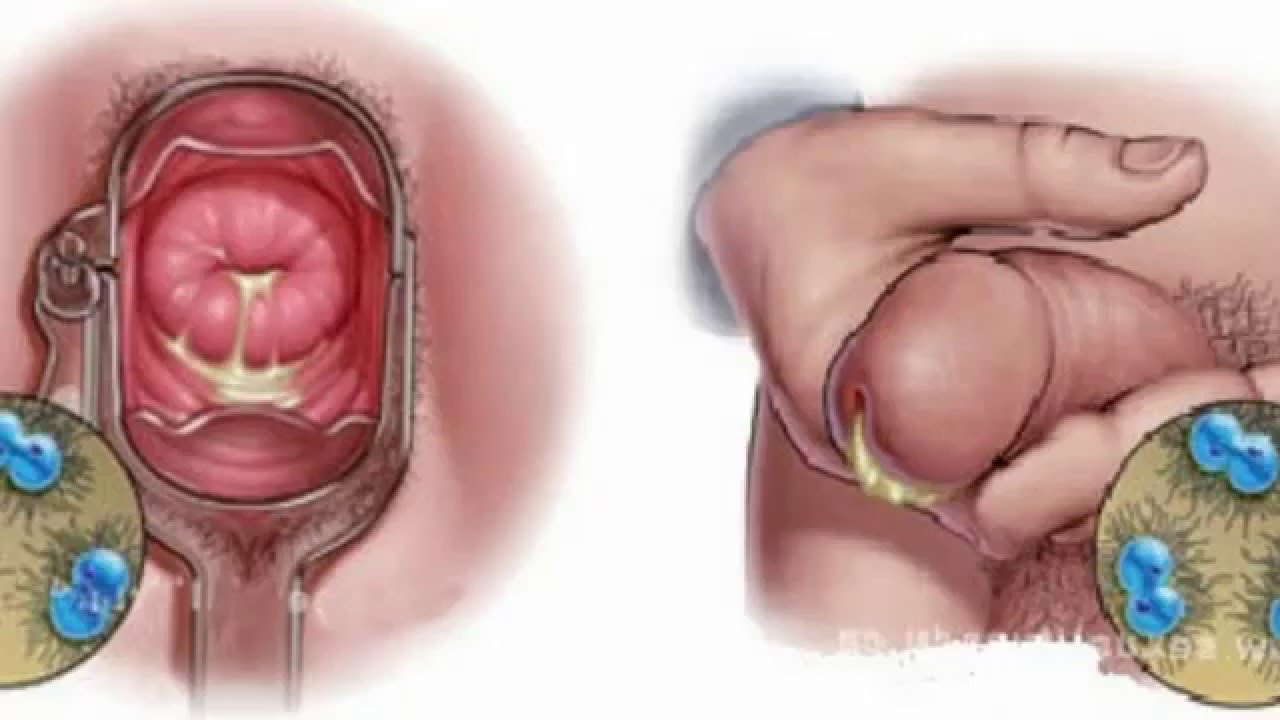gonorrea en hombres como se contagia