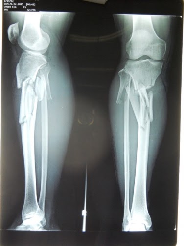 Orthopaedi Knowledges: MANAGEMENT OF LONG BONE FRACTURES
