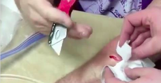 Cet homme s'ouvre un kyste sur le bras avec un cutter. Ce qui en sort m'a donné la gerbe!