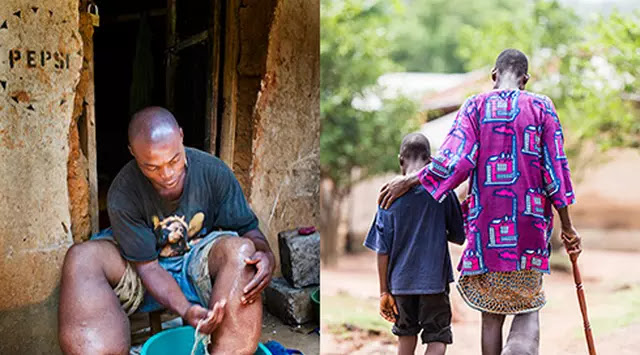 Kaki Gajah, Gigitan Nyamuk Membawa Cacing dan Berkembang Biak Hingga Badan Membengkak Kaki Gajah, Gigitan Nyamuk Membawa Cacing dan Berkembang Biak Hingga Badan Membengkak