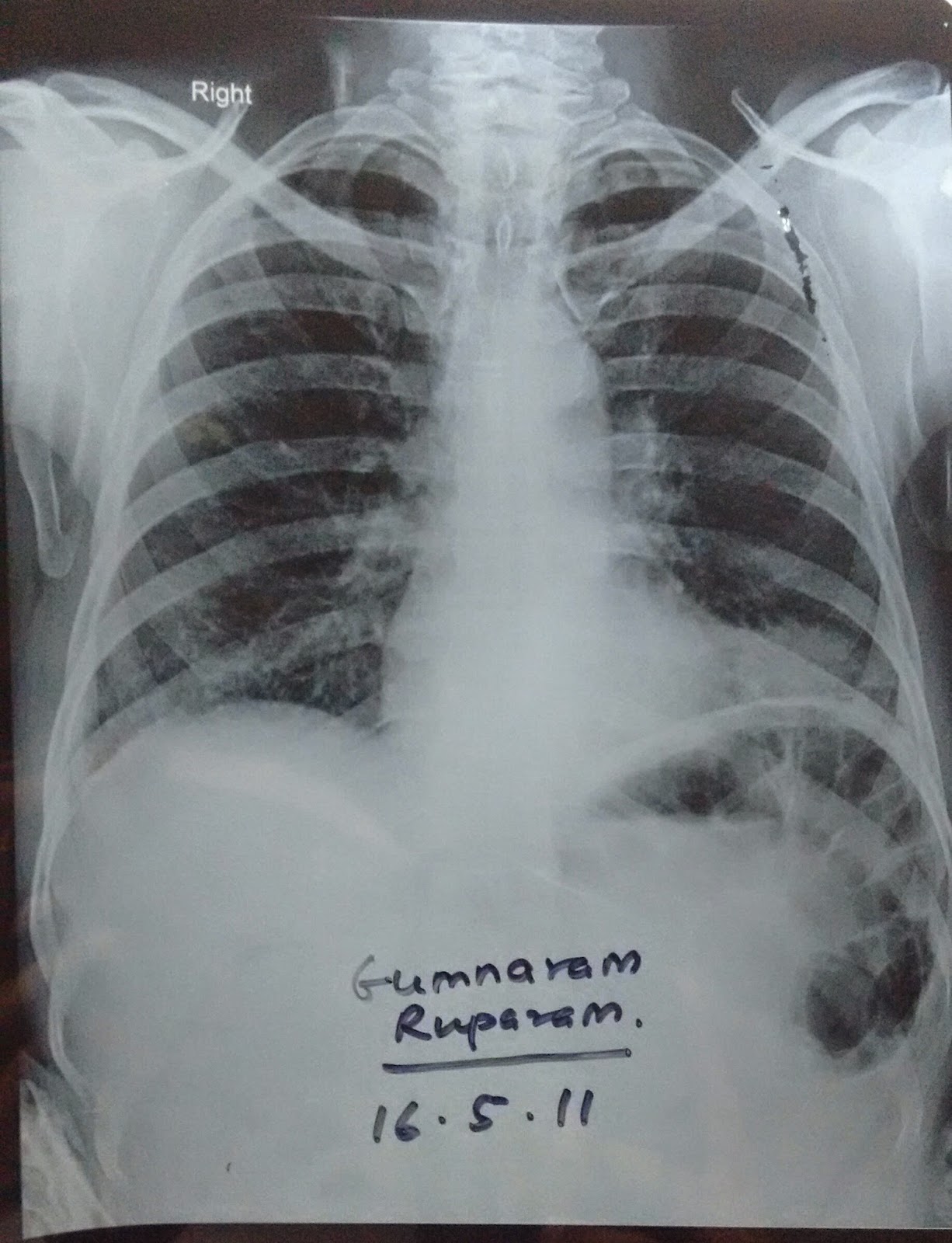 Chest Medicine Made EasyDr Deepu Chest X Ray The Diaphragm is unique