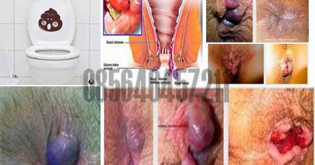 Berapa Lama Wasir Ambeien Bisa Sembuh Mitra Sehat Abadi Berapa Lama Wasir Ambeien Bisa Sembuh Mitra Sehat Abadi