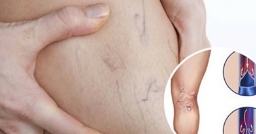 La varicosité profonde des veines des pieds
