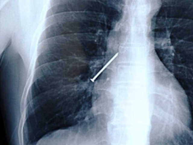 Radiografías de objetos en el estómago 