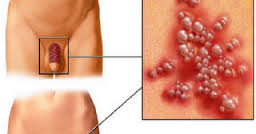 Obat Penyakit Sipilis Dari De Nature Obat Penyakit Sipilis Dari De Nature