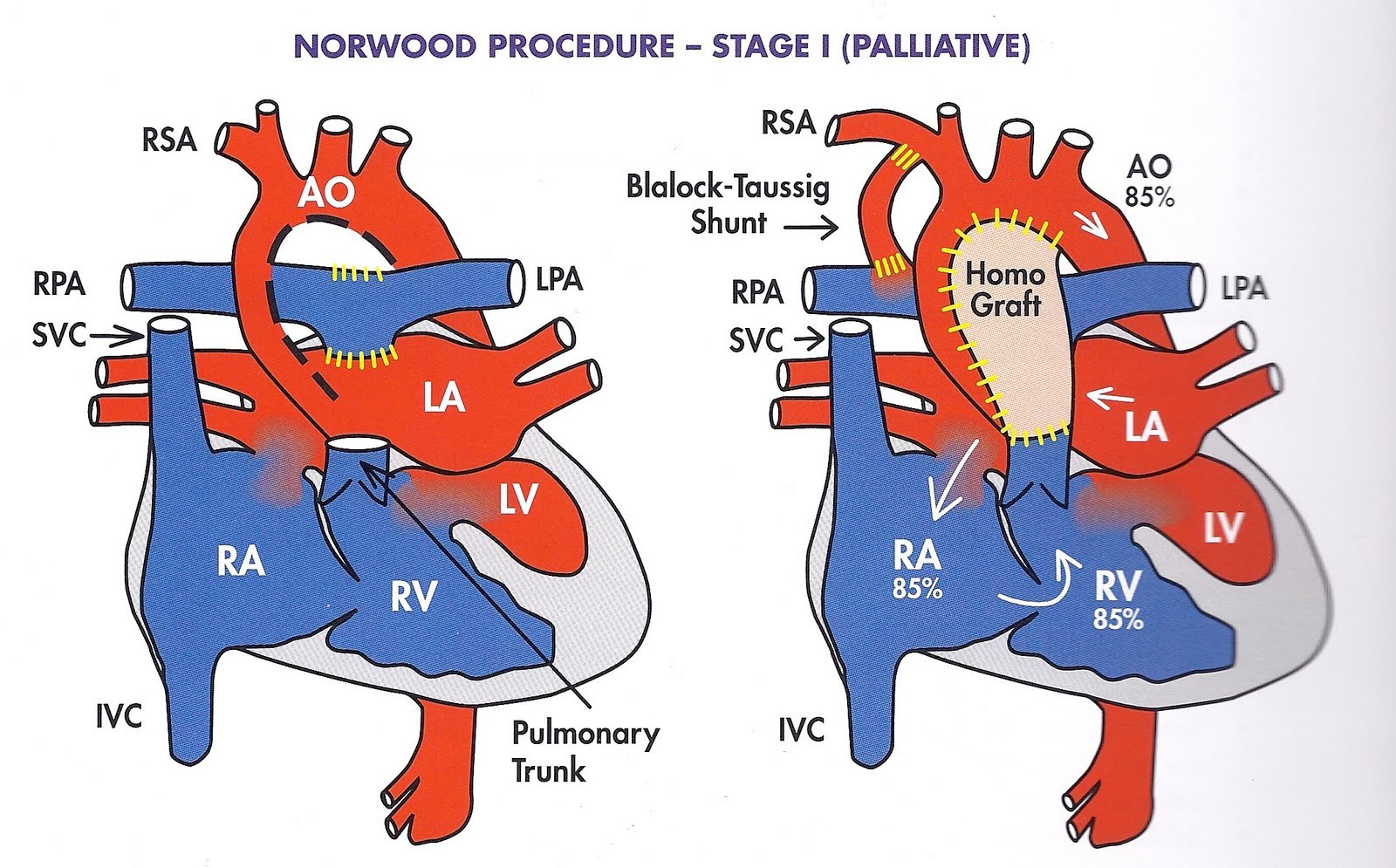 Norwood Procedure