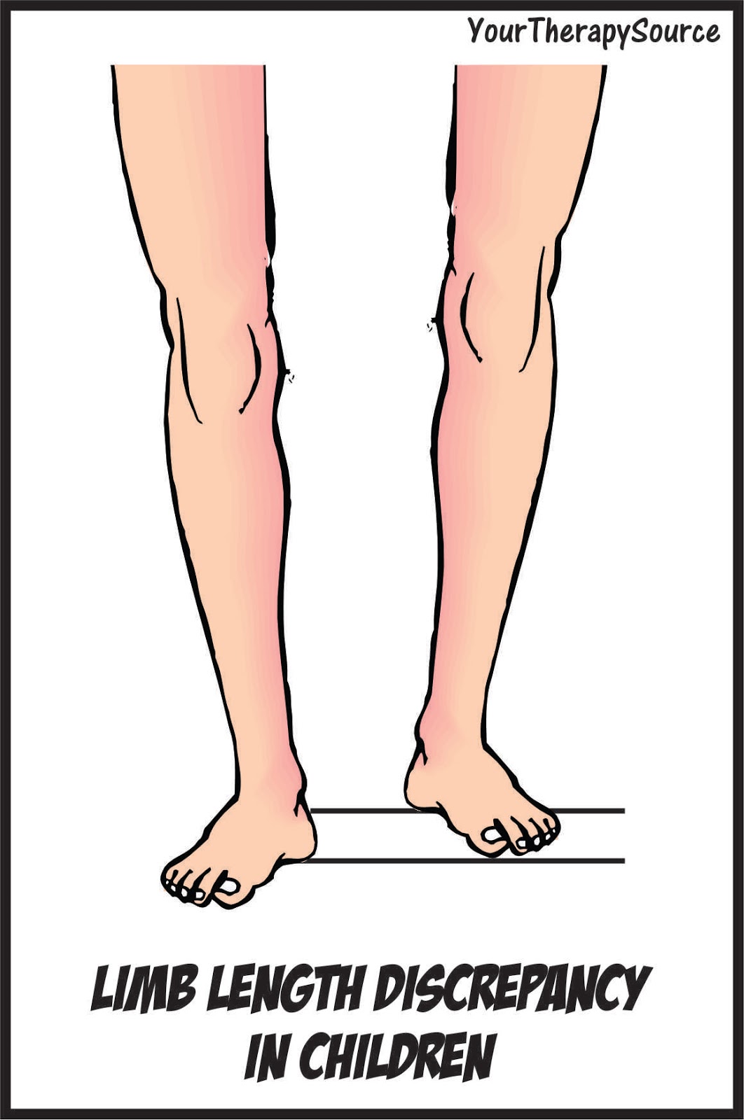 how to measure leg length discrepancy physical therapy