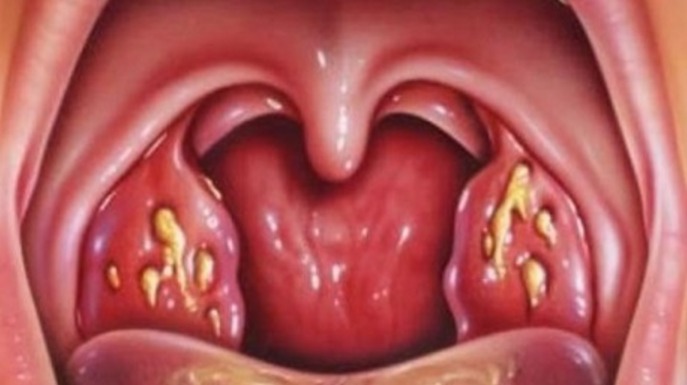 Squamous Cell Carcinoma Throat Survival Rate
