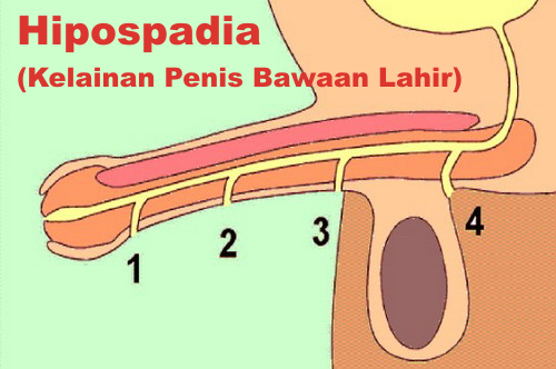 Penanganan Hipospadia Tanya Alodokter