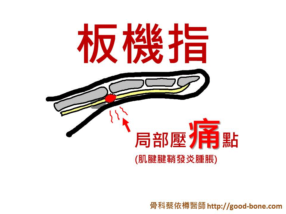 Homepage-TriggerFinger (2)