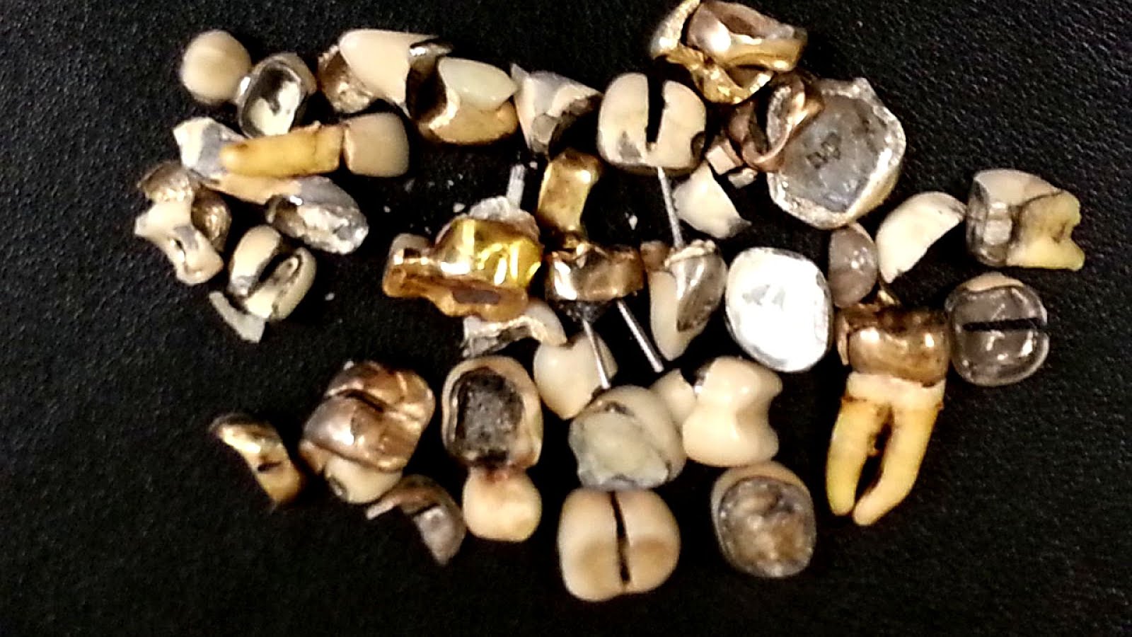 What Is Dental Gold Gold Choices