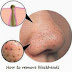 Natural home remedies for removing black heads