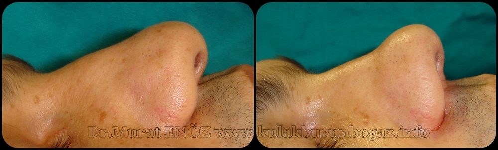 Burun Ucu Estetiği (Tip Plasti) Ameliyatı