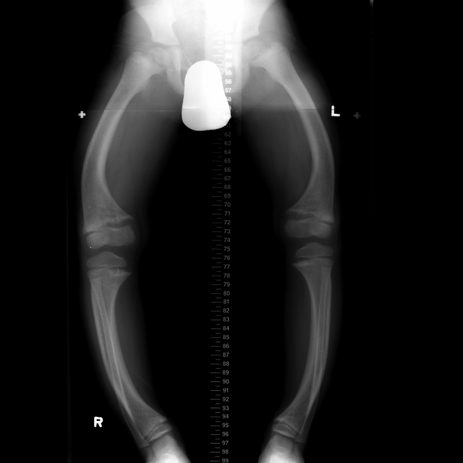 x-ray picioare varicoza