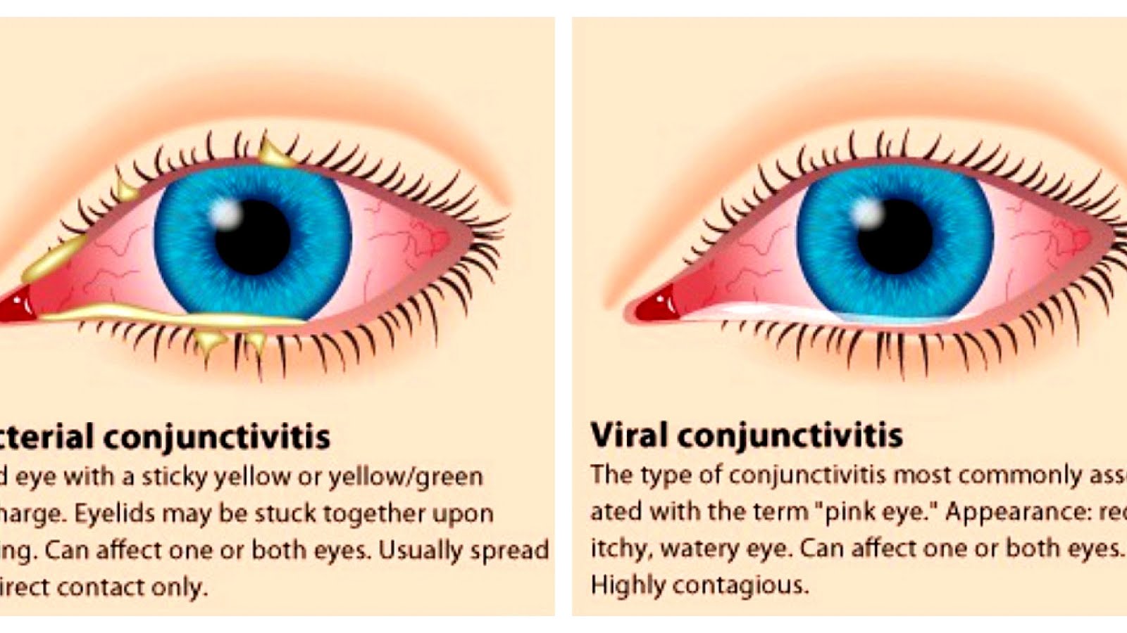How To Deal With Pink Eye Pink Choices