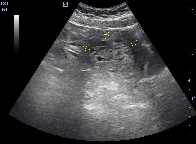 drhanif: Molar Pregnancy