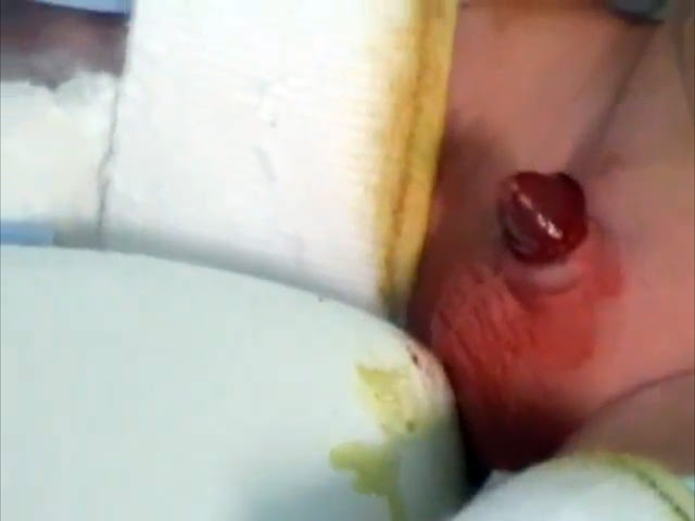 Saving Our Sons Neonatal Circumcision A Video For Heathcare