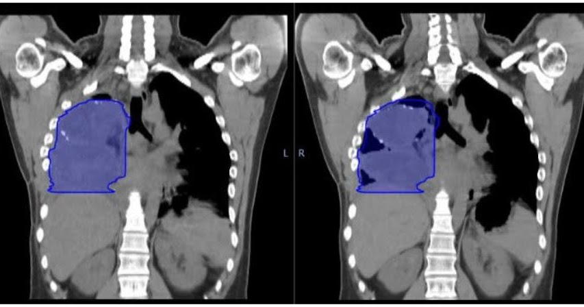 My Life with Stage IV Synovial Proton Therapy