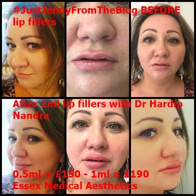 Lip Fillers By Dr Hardip Nandra