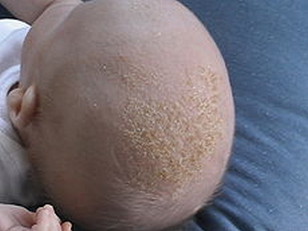 itchy rash on scalp #11