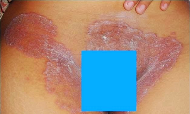 Obat Jamur Selangkangan Tradisional alami herbal