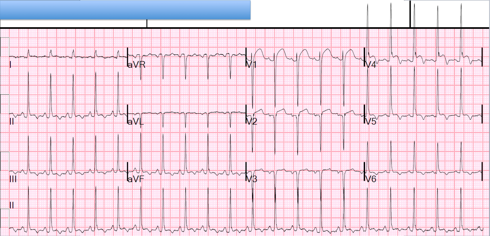 Учащение пульса. Почему учащается пульс. Давление при инфаркте. Таблетки при тахикардии сердца. Желудочковая тахикардия жалобы.