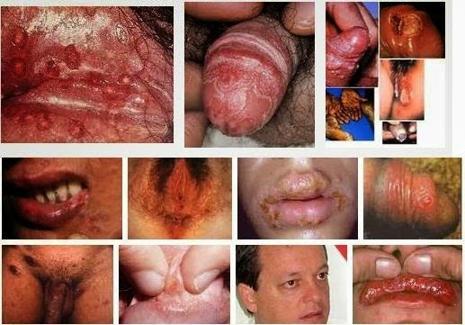 Apa Nama Obat Penyakit Sipilis | Obat Sipilis Ampuh Dan Mujarab