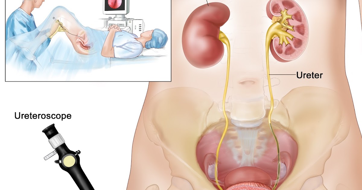 цистоскопия мочеточника