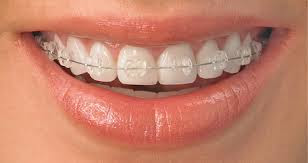 Khi niềng răng nên chọn loại mắc cài nào?