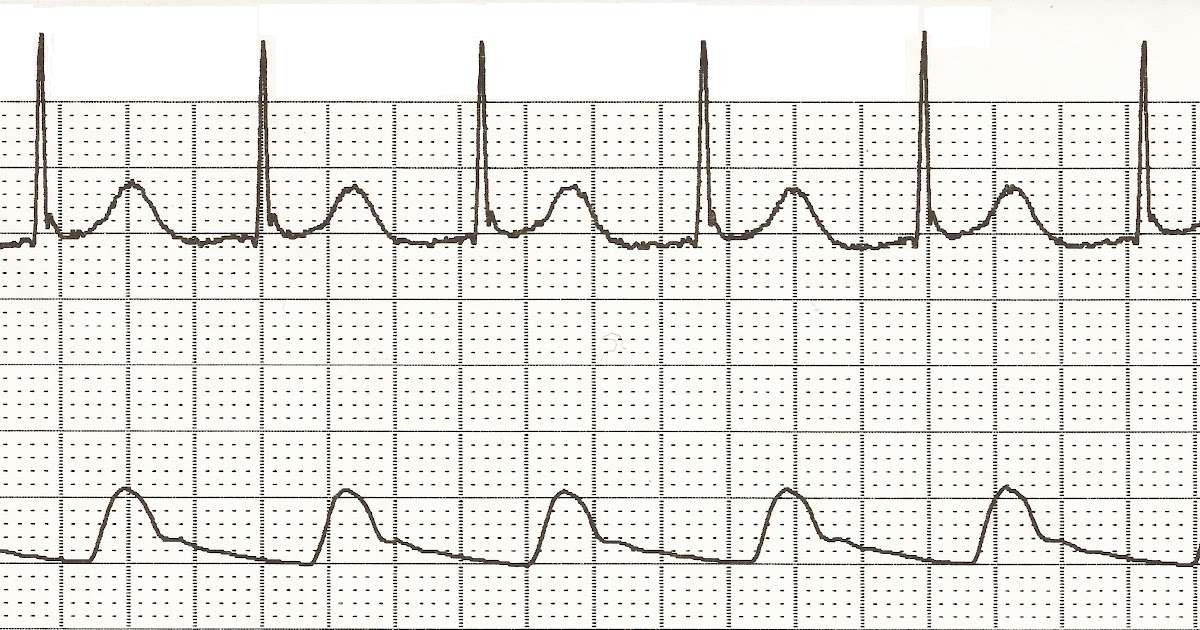 Ekg and rhythm strip, cote de pablo nude porn pics