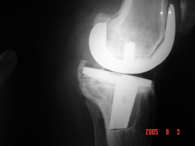 ossa-carpalia-artroplastia-total-de-rodilla-de-revisi-n