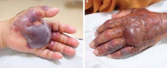 Người đàn ông Hàn Quốc bị cắt cụt tay vì ăn Hàu sống Người đàn ông Hàn Quốc bị cắt cụt tay vì ăn Hàu sống