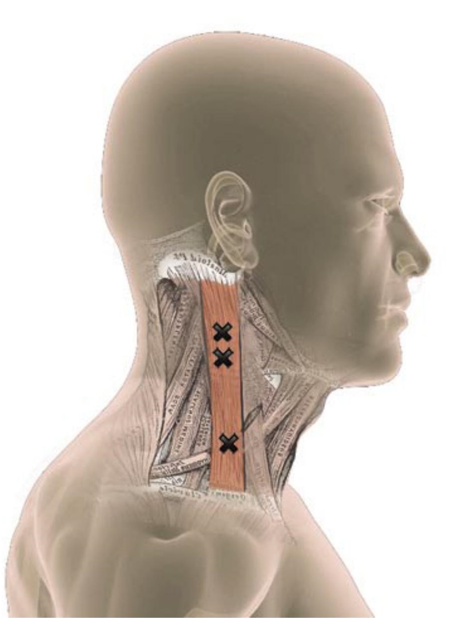 спазм шеи симптомы. миозит трапециевидной мышцы шеи. симптом передней лестничной мышцы. расслабление трапециевидной мышцы. мышечный спазм в шее.