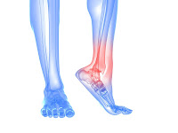 Ankle pain Prevention