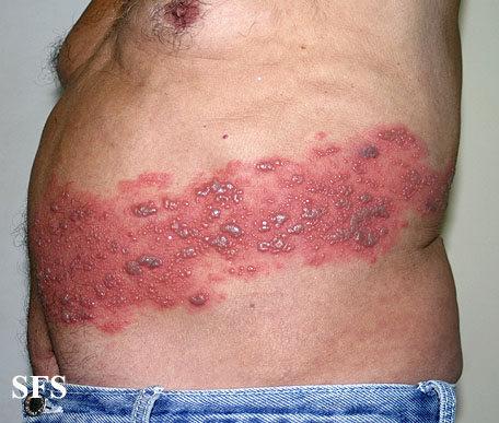 Skin Rash: 59 Pictures, Causes, Treatments - Healthline