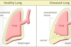 Mesothelioma Diagnosis Information : Understand the Diagnostic Process