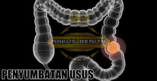 Menyumbatkan Usus Menyumbatkan Usus